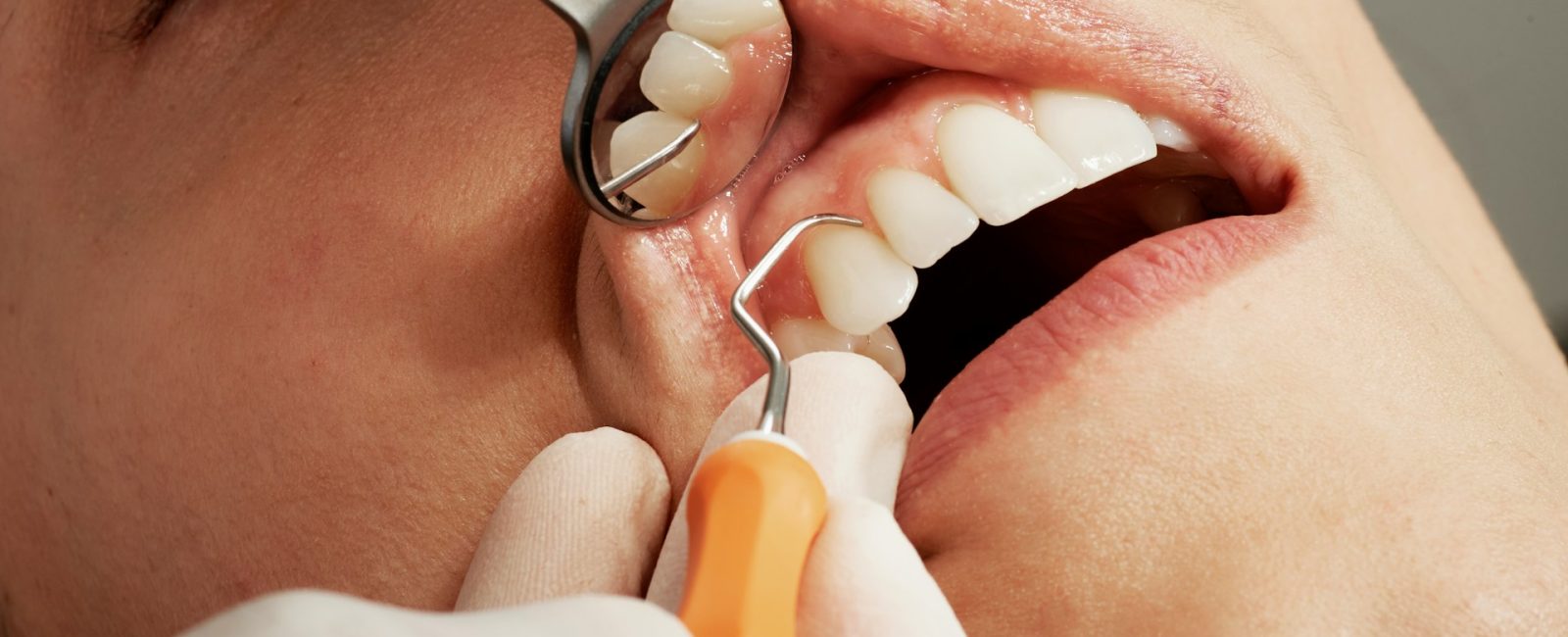 periodontal disease