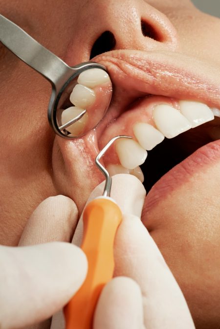 periodontal disease