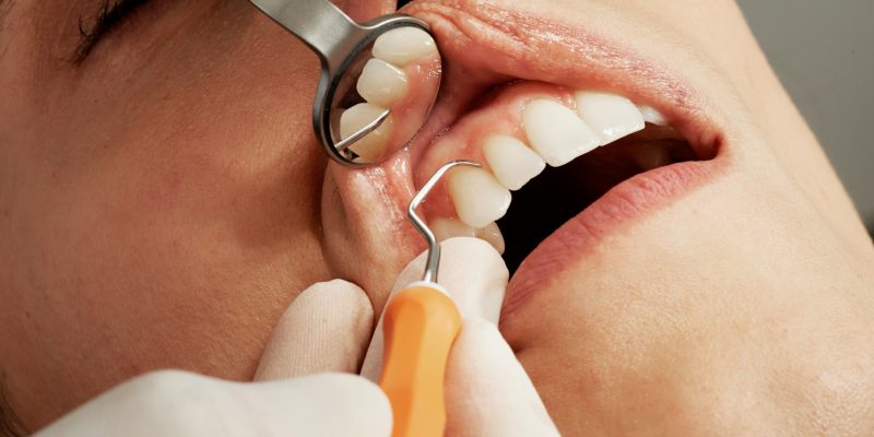 periodontal disease